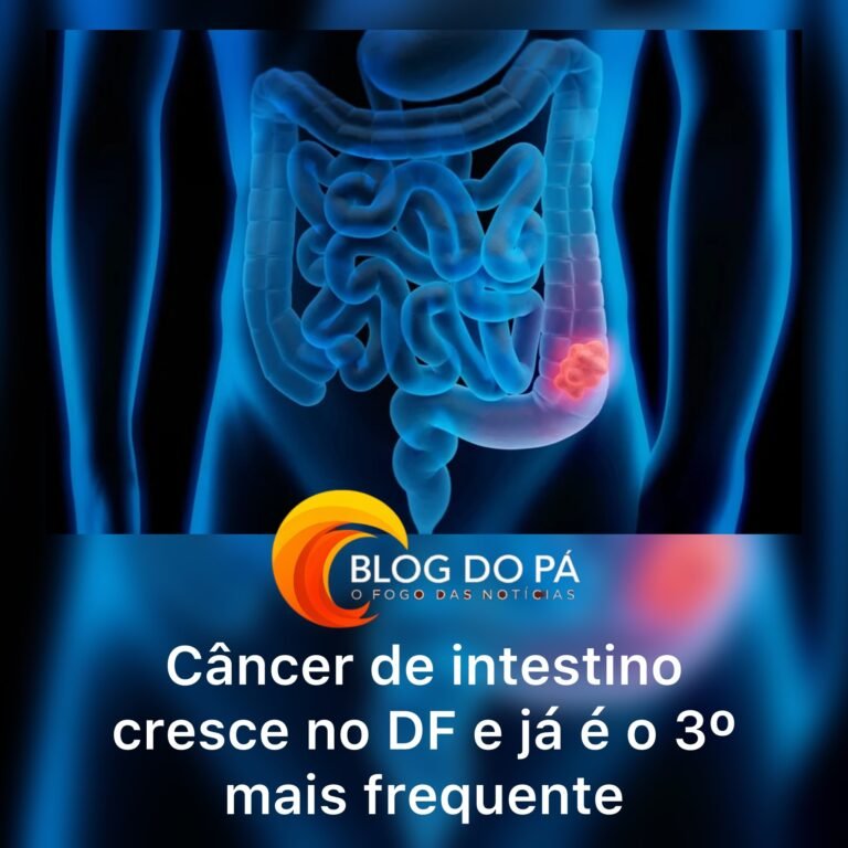 Blogdopa | Alerta no DF: câncer de intestino é o 3º mais comum; veja sintomas e tratamento